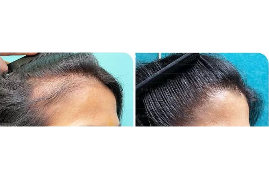 Hair transplant before and after in Delhi – 42-year-old female, Grade II, 2,200 grafts with EnRiched-FUE, result at 8 months (photo 2)