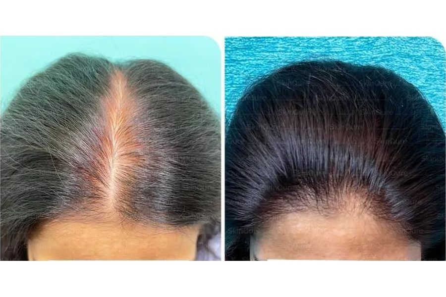 Hair transplant before and after in Delhi – 42-year-old female, Grade II, 2,200 grafts with EnRiched-FUE, result at 8 months (photo 3)