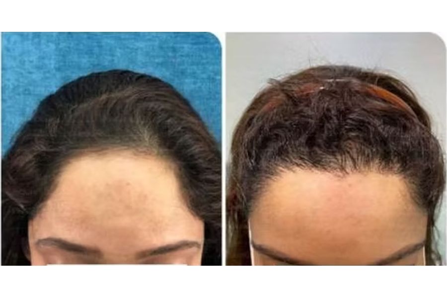 Hair transplant before and after in Delhi – 43-year-old female, Female Hairline, 2,200 grafts with EnRiched-FUE, result at 15 months (photo 1)