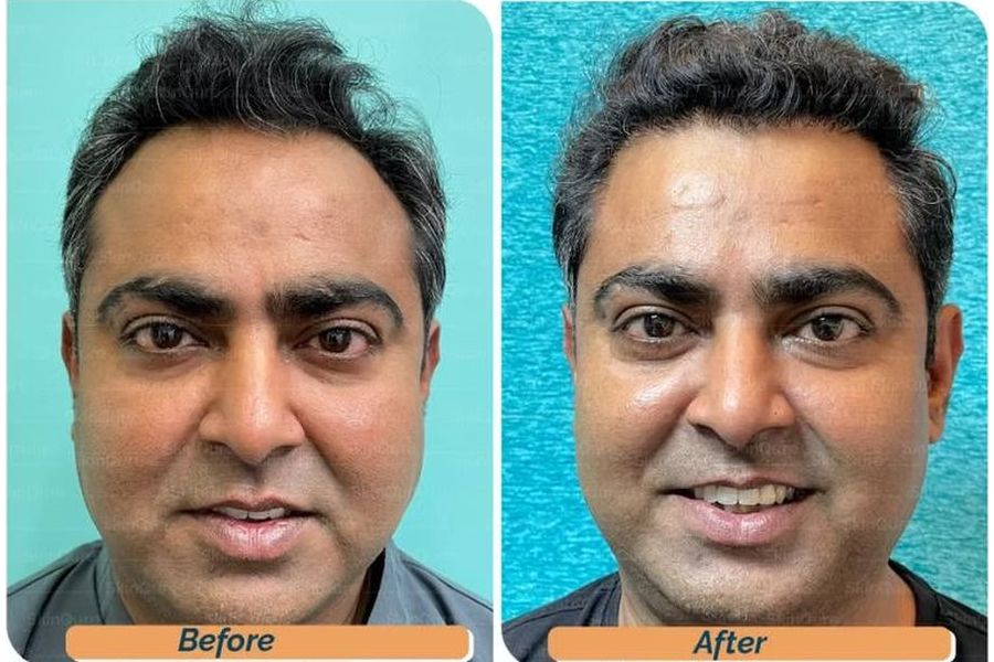 Hair transplant before and after in Delhi – 43-year-old male, AGA Grade III, 2,600 grafts with EnRiched-FUE, result at 9 months (photo 1)