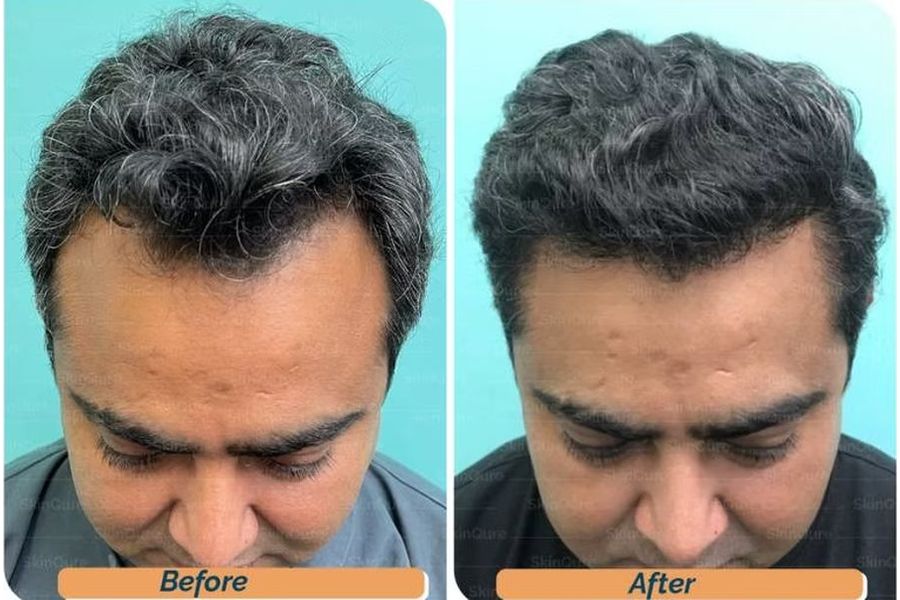 Hair transplant before and after in Delhi – 43-year-old male, AGA Grade III, 2,600 grafts with EnRiched-FUE, result at 9 months (photo 2)