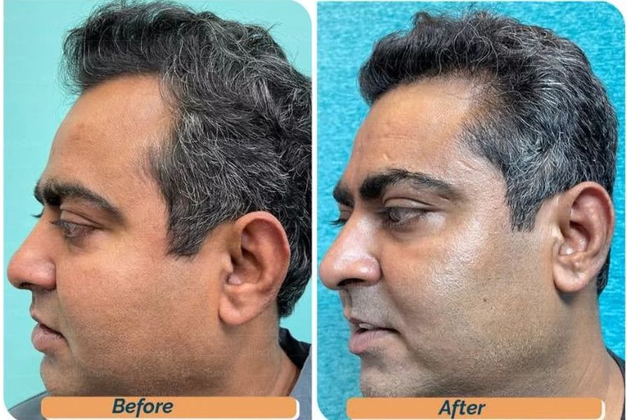 Hair transplant before and after in Delhi – 43-year-old male, AGA Grade III, 2,600 grafts with EnRiched-FUE, result at 9 months (photo 3)