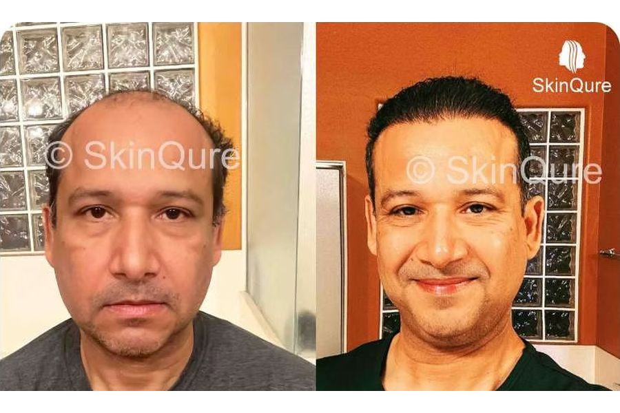 Hair transplant before and after in Delhi – 45-year-old male, Norwood VII, 5,500 grafts with EnRiched-FUE, result at 8 months (photo 1)