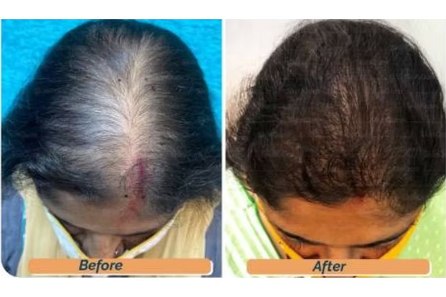 Hair transplant before and after in Delhi – 55-year-old female, Ludwig III, 2,000 grafts with EnRiched-FUE, result at 15 months (photo 1)