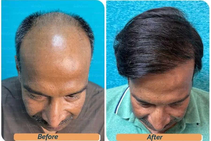 Hair transplant before and after in Delhi – 64-year-old male, Norwood VII, 6,500 grafts with EnRiched-FUE, result at 12 months (photo 1)