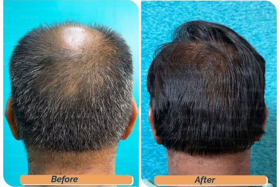 Hair transplant before and after in Delhi – 64-year-old male, Norwood VII, 6,500 grafts with EnRiched-FUE, result at 12 months (photo 2)