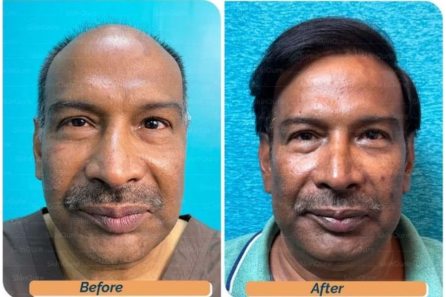 Hair transplant before and after in Delhi – 64-year-old male, Norwood VII, 6,500 grafts with EnRiched-FUE, result at 12 months (photo 3)