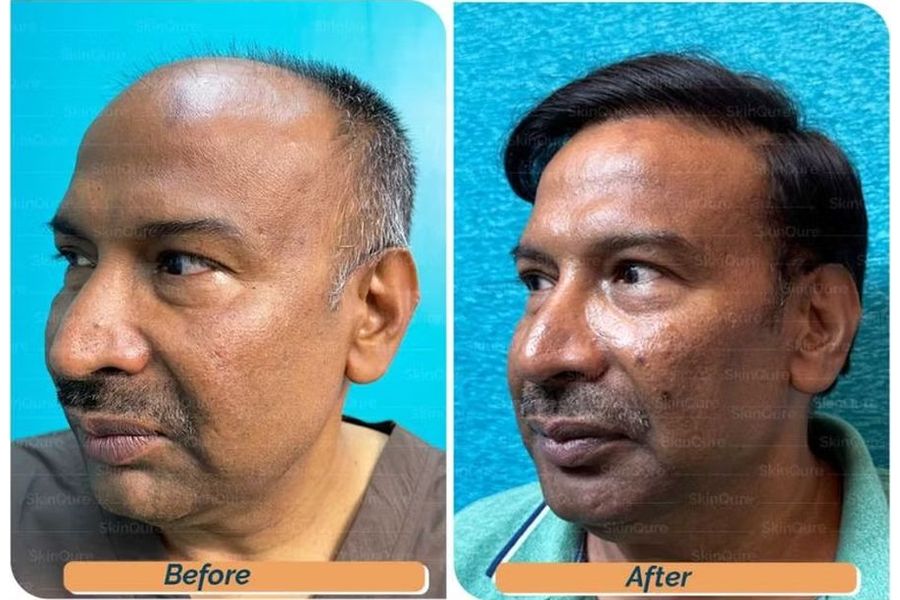 Hair transplant before and after in Delhi – 64-year-old male, Norwood VII, 6,500 grafts with EnRiched-FUE, result at 12 months (photo 4)