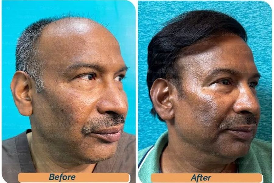 Hair transplant before and after in Delhi – 64-year-old male, Norwood VII, 6,500 grafts with EnRiched-FUE, result at 12 months (photo 5)