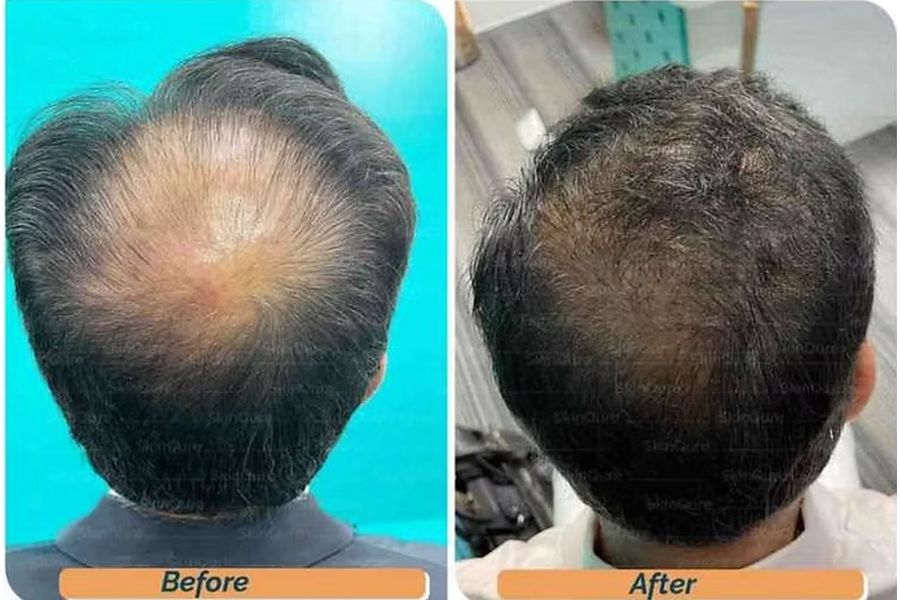 Hair transplant before and after in Delhi – 72-year-old male, Norwood VIIa, 3,800 grafts with EnRiched-FUE, result at 11 months (photo 1)