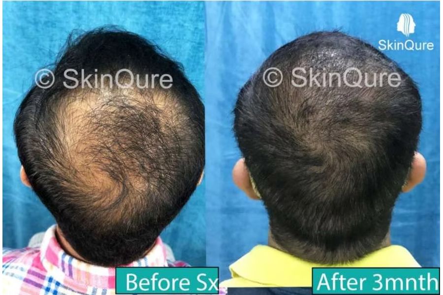 Hair transplant before and after in Delhi – 72-year-old male, Norwood VIIa, 3,800 grafts with EnRiched-FUE, result at 11 months (photo 2)