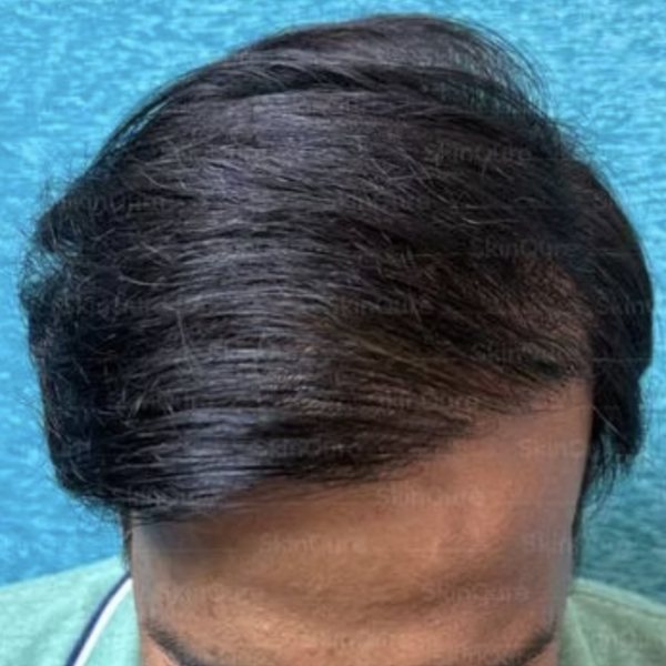 Result 12 months after EnRiched-FUE hair transplant with 6,500 grafts