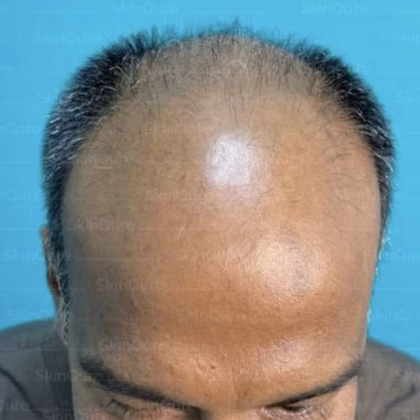 Norwood grade VII baldness before transplant