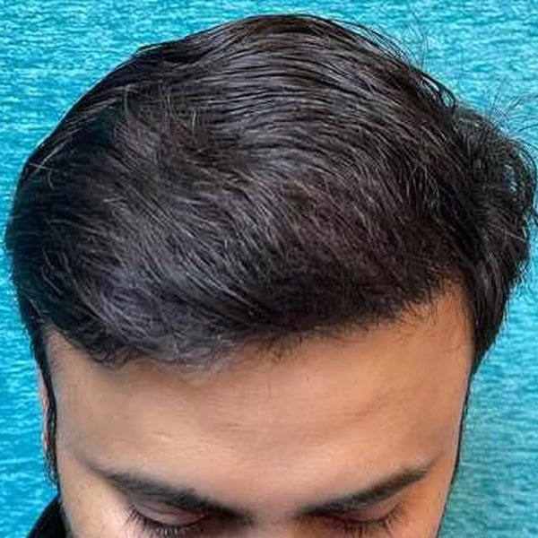 Result 8 months after EnRiched-FUE hair transplant with 3,010 grafts