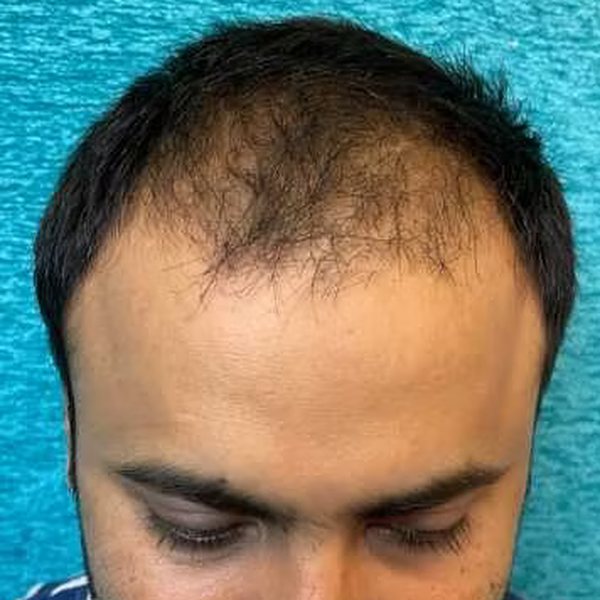 Norwood grade IV hair loss before transplant
