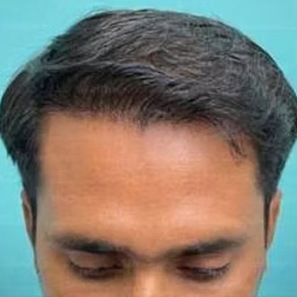 Result 8 months after EnRiched-FUE hair transplant with 3,200 grafts