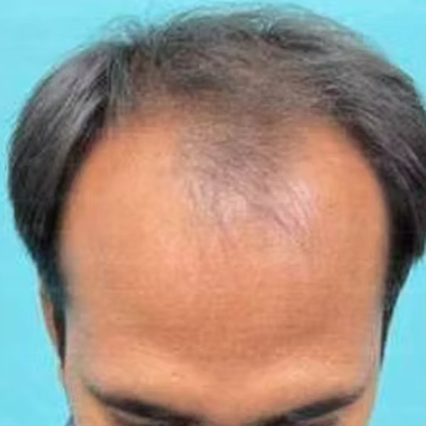 Norwood grade IV hair loss before transplant